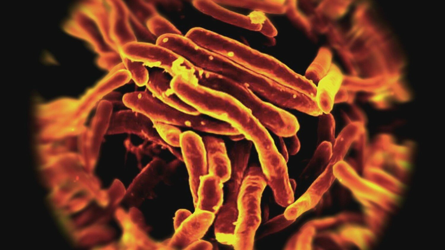 В Австралии свирепствует безжалостная плотоядная бактерия 